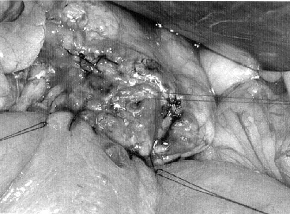 Slika 9. Duct-to-mucosa pankreatikojejuno anastomoza Imaizumi 2006 46 Slika 10.