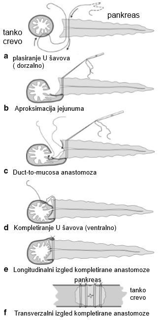 Slika 15. Blumgartova anastomoza: a-e) longitudinalni presek; f) transverzalni presek.