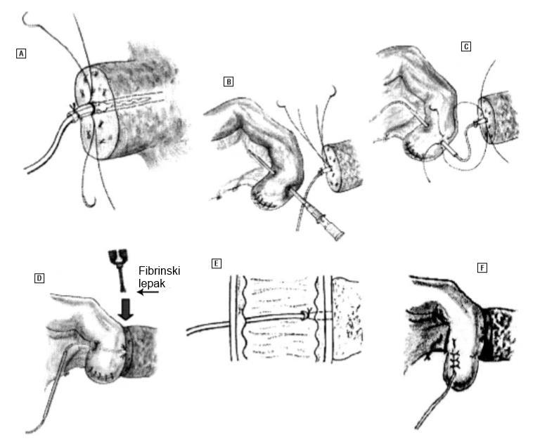 Invaginirajuća anastomoza pankreasnog kanala (Suzuki, Kuroda 2002) 51 Slika 21. A.