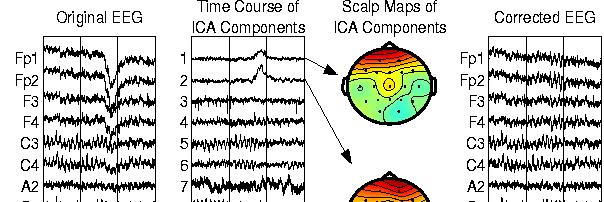 Example 2 Removing blink and muscle artifacts The figure shows a 3-sec portion of the recorded EEG time series and its ICA component