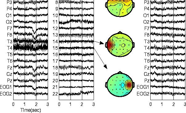 selected EOG and muscle noise components from the data. The eye movement artifact at 1.