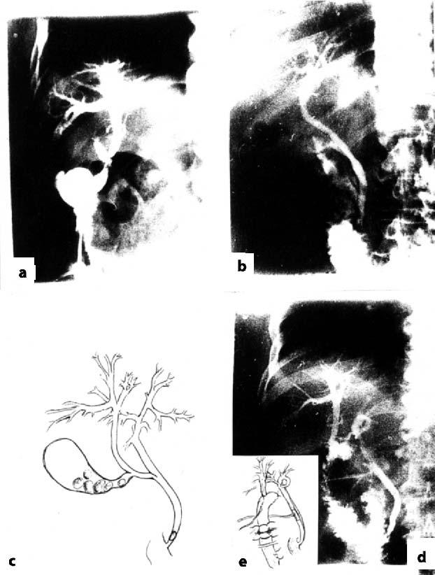 (strelica prikazuje ulivawe cis - tikusa u predwi sektorski žuèni vod); d) Holangiografija kroz transintestinalni dren prikazuje anastomozu predweg sektorskog voda i crev vijuge po Ruu. FIGURE 1.