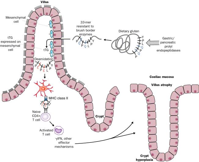 Immunopathogenesis of Celiac Disease MN Marsh Gastroenterology 102: 330;1992 Modellvorstellung der Interaktionen zwischen Protein-Prozessierung und spezifischen Immunreaktionen im Darm bei Zoeliakie.