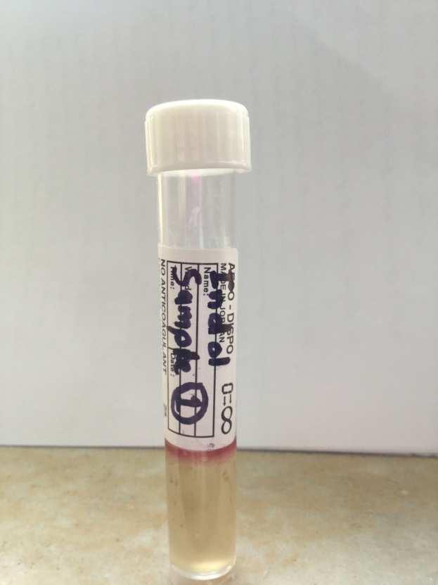 The positive result is indicated by the red layer at the top of the tube after the addition of Kovács reagent.as shown in fig. (6). Fig.