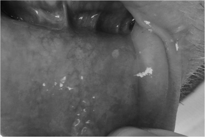 Dental and Oral Considerations in Pediatric Celiac Disease.