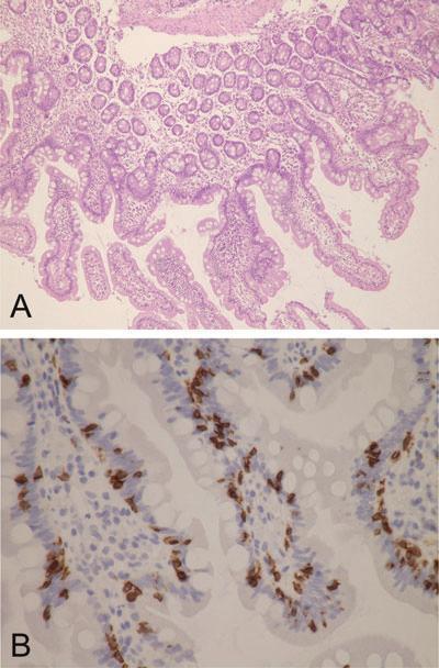 Pathological findings in CD - intestinal Duodenal biopsy. Routine HE stain revealed no relevant duodenal atrophy (A).