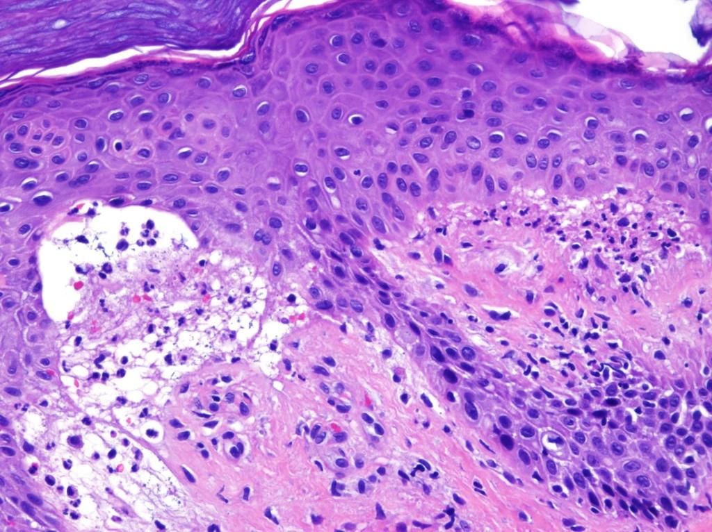 2/10/18 Case #1 Biopsy recommendations Lesional biopsy for H & E Perilesional biopsy for