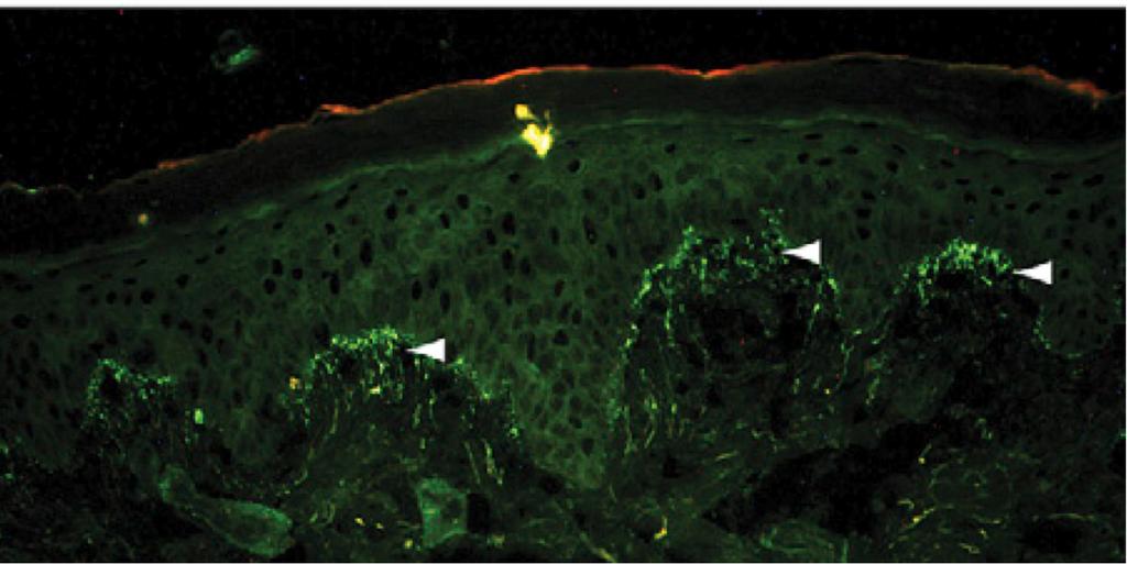 formation Granular IgA in the dermal papillae Courtesy of Laura Pincus, M.D.