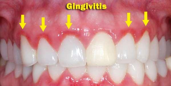 Gingivitis: A swelling and soreness of the gums that, without treatment, can