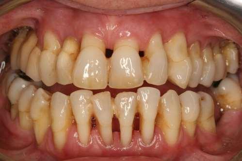 If left unchecked, gingivitis can