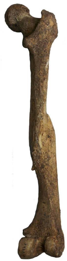 The two femora (upper leg bones) shown here provide an example of a healthy bone on the left and a bone with an