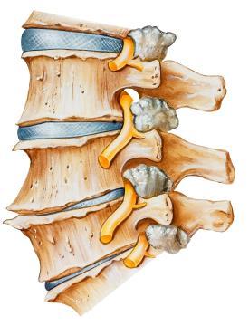 Pathologies and Disease The Carrier Mills Archaeological Project Degenerative Disc Disease (DDD), also known as Spondylosis, is a disease that plagued ancient humans as much as it affects us today in