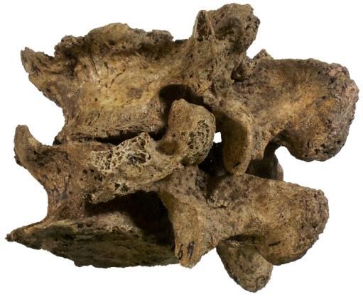 The vertebra column pictured on the right shows an individual from Carrier Mills with severe DDD.