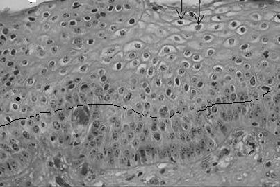 Strelice ukazuju na koilocite u gornjim segmentima Cervikalne intraepitelne neoplazije srednjeg stepena (CIN 3) (sli ka 3) Slika 3.