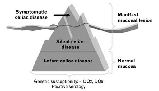 Epidemiology Celiac iceberg was coined to describe the wide variations in the nature and intensity of clinical presentation of which overt celiac disease is only the emerging peak.