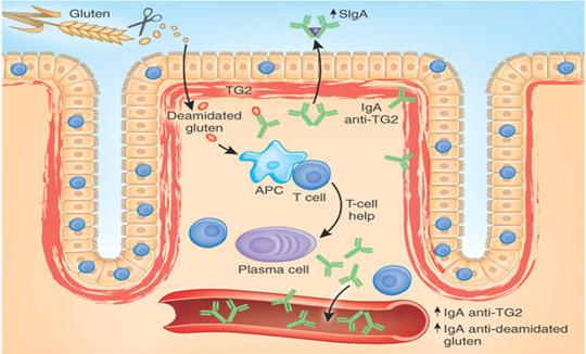 cells Red: Plasma cells autoantibodies to tissue transglutaminase (TG2) Courtesy of dr.