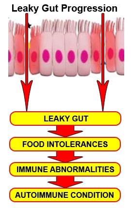 Leaky gut syndrome occurs when the lining of the intestines is weakened so that large spaces occur between the cells of the gut wall allowing