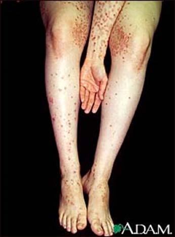 What is Dermatitis Herpetiformis (DH)?