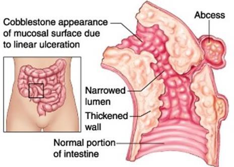 Crohn s disease CROHN S DISEASE THE WHOLE GI TRACT CAN BE AFFECTED FROM THE ORAL CAVITIY TO THE ANUS IN 70% THE LARGE BOWEL IS AFFECTED SEGMENTAL PRESENCE OF THE DISEASE SKIP LESIONS TRANSMURAL