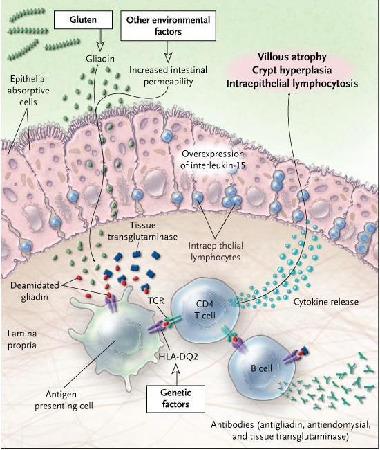 PATHOGENESIS OF CELIAC DISEASE GLIADIN ZONULIN ttg TIGHT JUNCTION DISRUPTION LEAKY GUT DEAMIDATED GLIADIN ANTIGEN PREZENTING CELLS (APC) HLA-DQ2 / HLA-DQ8 CD4 + T-LYMPHOCYTES cytokines B-LYMPHOCYTES