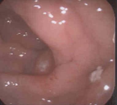 Case: Silent Celiac Disease in Patients with Co-morbid Conditions 12 year old female with Type 1 diabetes, no GI symptoms and a positive serology for celiac