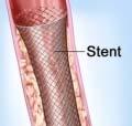Stent positioned in the oesophagus ( gullet) Following the insertion of a stent it is recommended that you follow a soft diet.