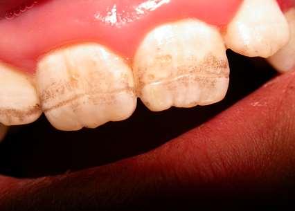 Dental Enamel Defects Involve the secondary