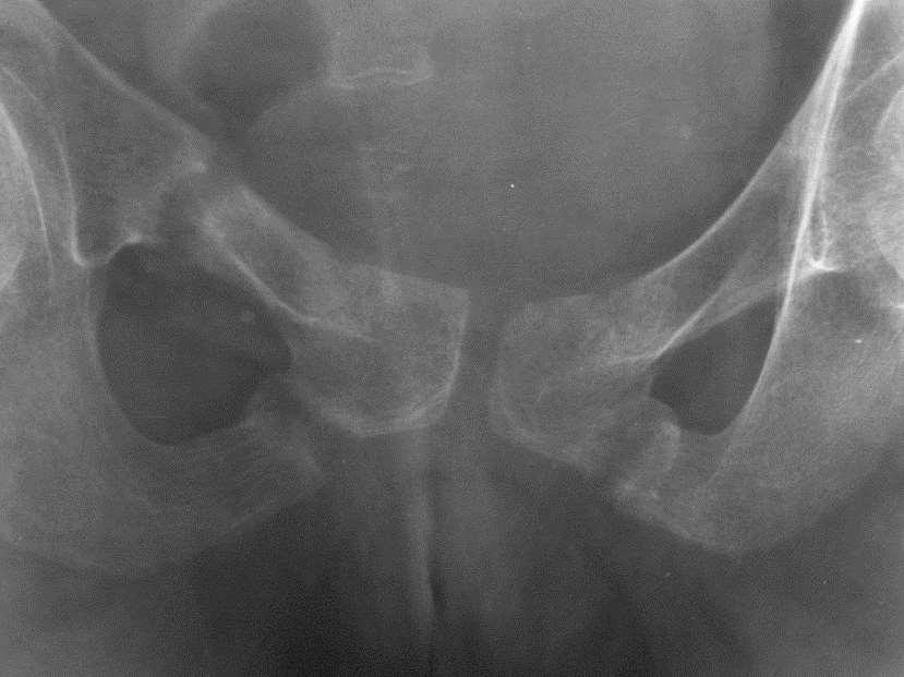 Osteoporosis Low bone mineral density