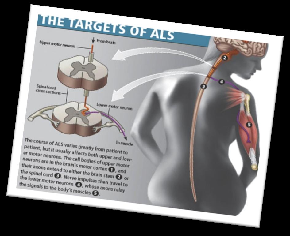 As ALS is a progressive disease, more motor neurons are destroyed overtime worsening the symptoms.