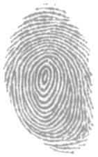 Fingerprints May Offer Some Clues We conclude that particular dermatoglyphic [fingerprint] patterns are significantly more common in