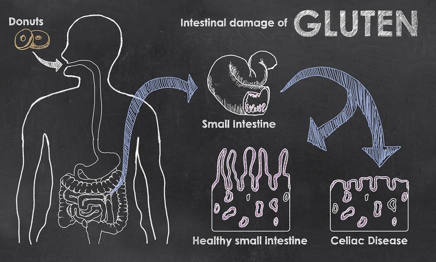 What is gluten intolerance / Coeliac disease? Gluten is a protein present in the grains of wheat, rye, oats and barley and the derivatives from those.