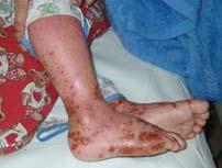 with eczema, possibly much less in children with mild eczema