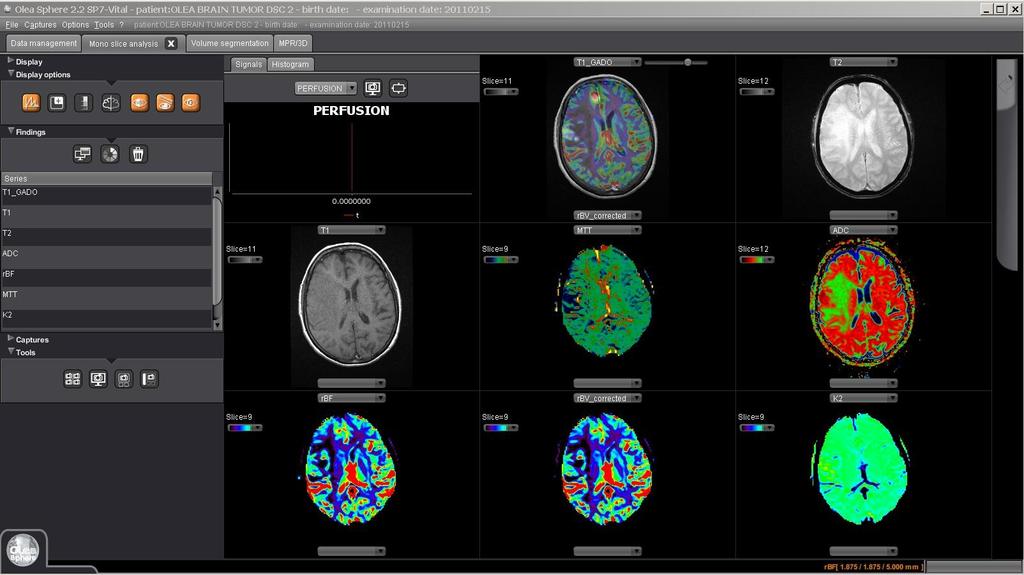 Olea Tumor Basic-Maps and Overlays Click on the drop down