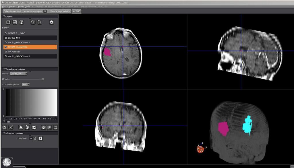 Olea Tumor Basic- MPR/3D Click on MPR/3D to view data in MPR views and 3D. Place a check next to which series to display.