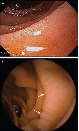 Endoscopic evaluation Gross Findings Scalloping Fold flattening Fissuring Nodular mucosa NOTE: Absence of visual endoscopic findings does not exclude