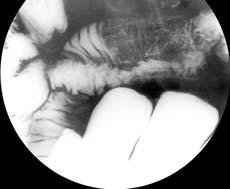 Celiac Disease: Acute Abdomen Mimic partial small bowel obstruction Perforation