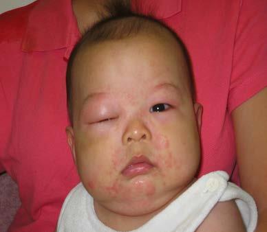 The prevalence of food allergy seems to have increased in China.