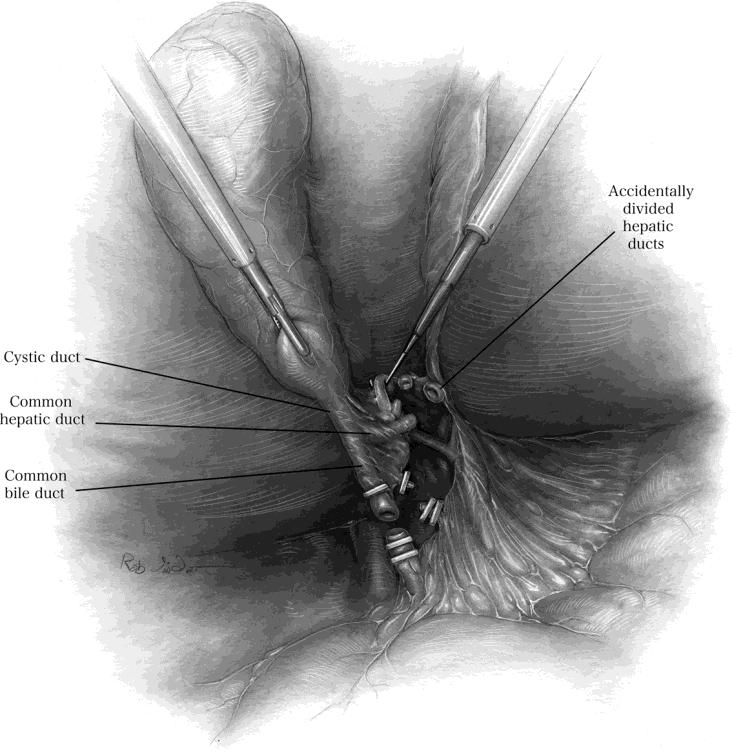 Slika 9 Klasiĉna laparoskopska povreda ţuĉnih vodova Misidentifikacija dovodi do klipsovanja i resekcije glavnog žučnog voda kao i transekcije proksimalnog dijela hepatičnog žučnog voda.