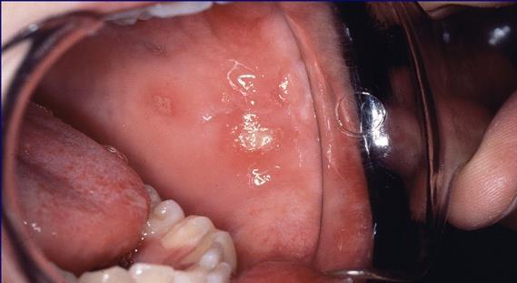 Recurrent Apthous Stomatitis By