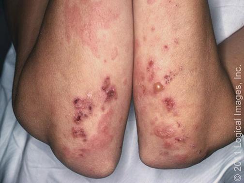 papules and vesicles that occur in