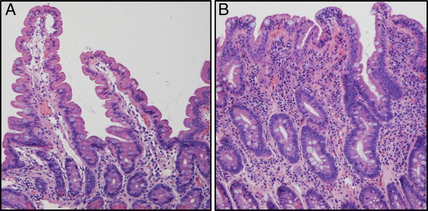 Figure. Representative histologic features of the small intestine. In the normal duodenal biopsy (A), the villi are elongated and the crypts relatively short.