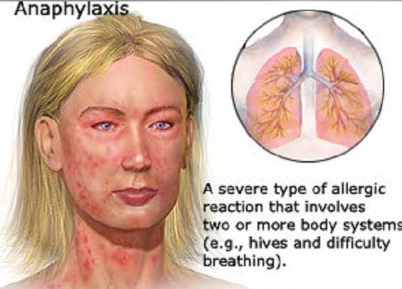 Symptoms of a Serve Food Allergic Reaction Respiratory: Shortness I of breath, difficulty swallowing, chest tightness, tingling of the mouth Itching