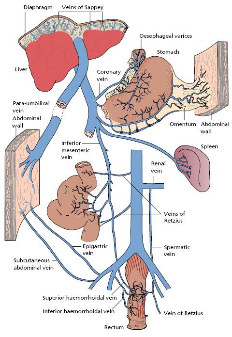 Slika 4 Porto-sistemske kolaterale u cirozi jetre (izvor: Burroughs