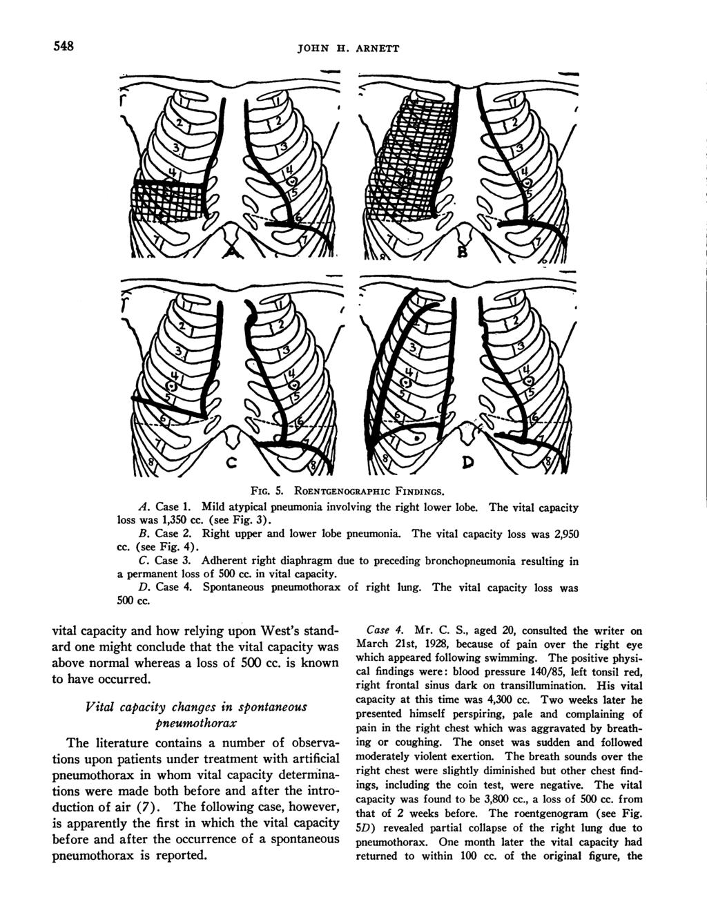 548 JOHN H. ARNETT FG. 5. ROENTGENOGRAPHC FNDNGS. A. Case. Mild atypical pneumonia involving the right lower lobe. The vital capacity loss was,350 cc. (see Fig. 3). B. Case 2.