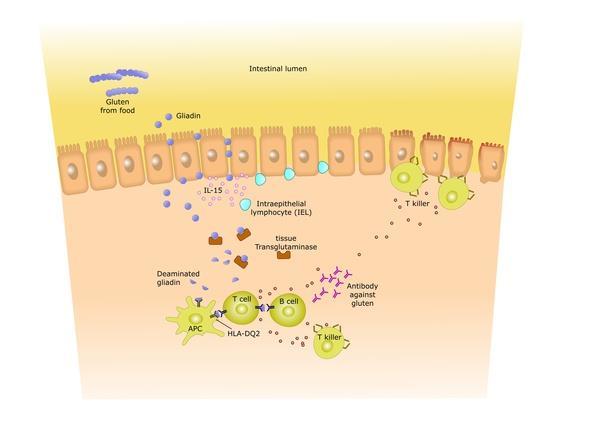 Synergetic effect both gluten and TG oocytes activating a mixed inflammatory response leading to a severe mucosal damage in susceptible individuals T.