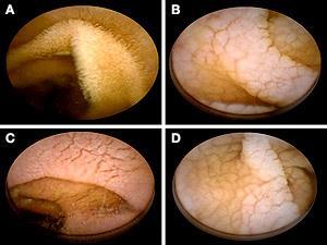 Endoscopy Examples of macroscopic features of villous effacement detected by wireless capsule endoscopy in celiac disease: A) Normal villi, B)
