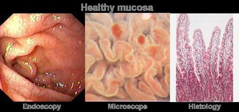 Definition of normal mucosa Marsh MN, Rostami, K.