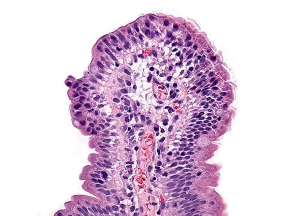 duodenal biopsies Giardia intestinalis 28