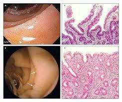 Healthy vs Disease Endoscopy Normal Celiac Disease Figure 3: Endoscopic and biopsy findings in patients with and without celiac disease. (American Family Physicians.
