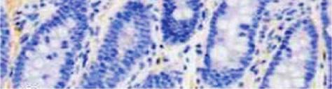 (b) Positive staining in both surface mucosa and in crypts. (c) Absence of staining in both surface epithelium and crypts. (immunoperoxidase 20x). 4.